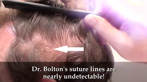 Hair Restoration Scar Results by Dr. Brett Bolton