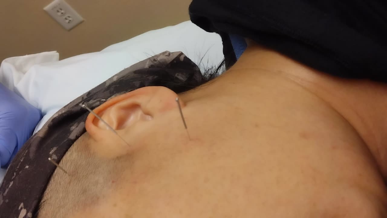 #dryneedling