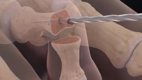 Hammer Toe Surgery 3D Animation