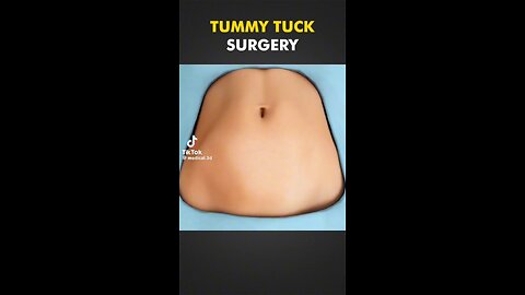 Tummy tuck surgery