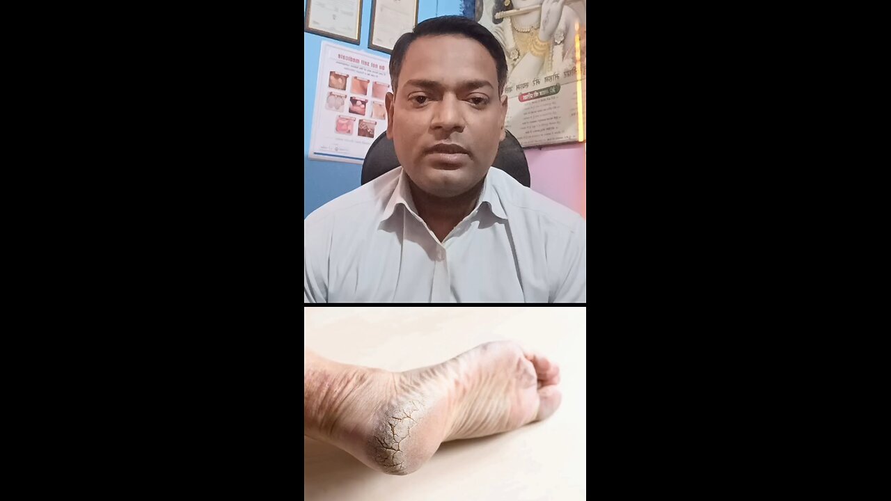 फटी एड़ियों का इलाज ।