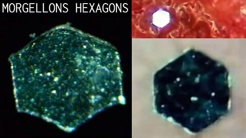 "Unveiling the Mystery: Morgellons Hexagons and Extreme Censorship by Nicholson1968"