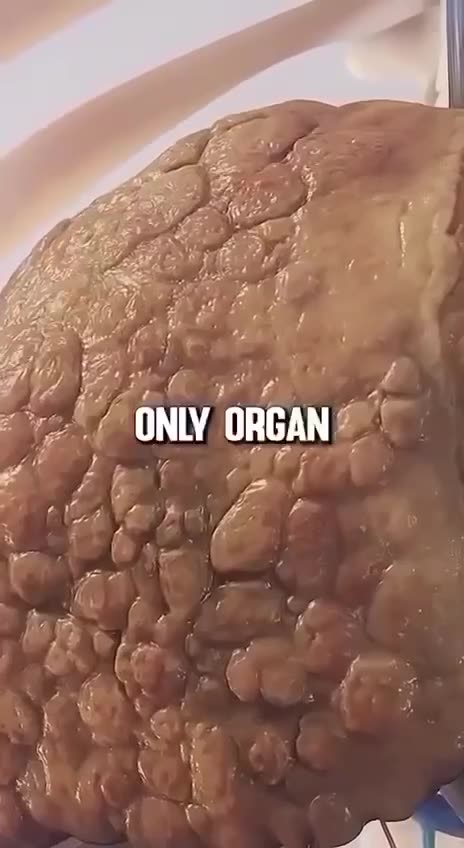 ‼️ CANCER STARTS IN THE GUT