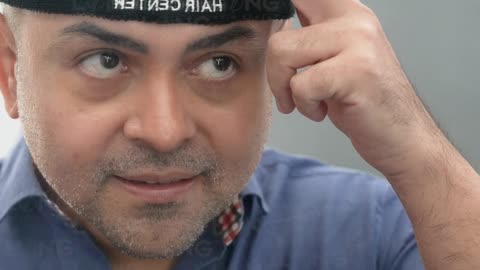 We take great care in achieving natural results in hair transplants