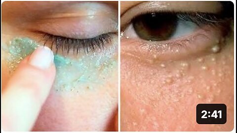 "Safe, Easy & Scar-Free Home Remedies for Eliminating Milia"