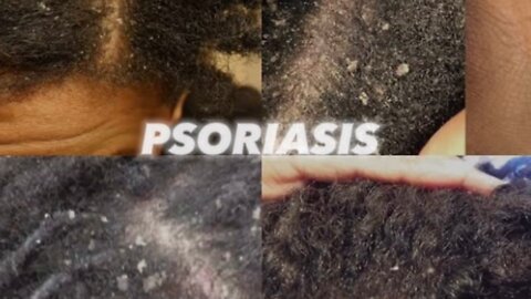 Dandruff Scratching+wash day #psoriasis #dandruff #asmr