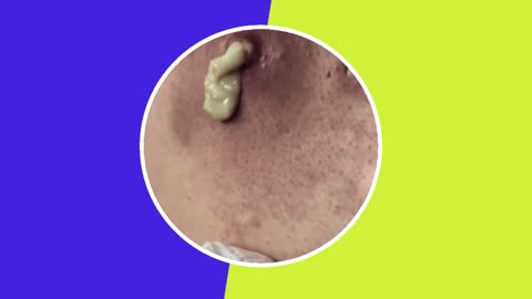 【毛穴 角栓 美容医療】Pimple Removal Satisfying Video (ASMR) #4