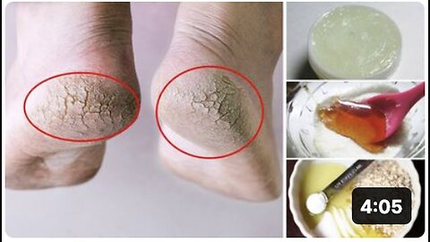 "Quick Remedies for Dry Feet and Cracked Heels"