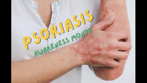 Psoriasis with Dr. Rosanne Paul