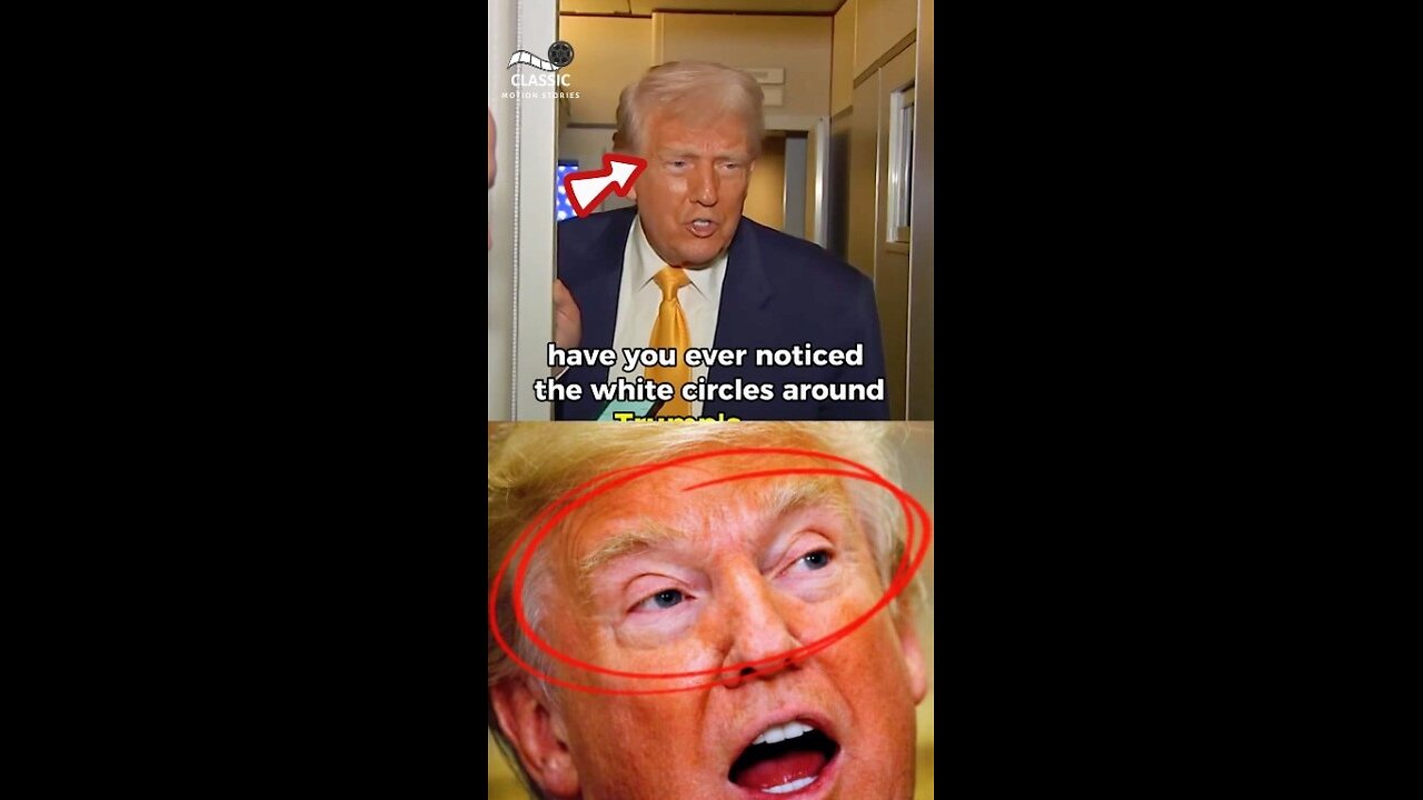 Why Does Trump Have White Circles Around His Eyes? 😳 The Real Reason Will Shock You