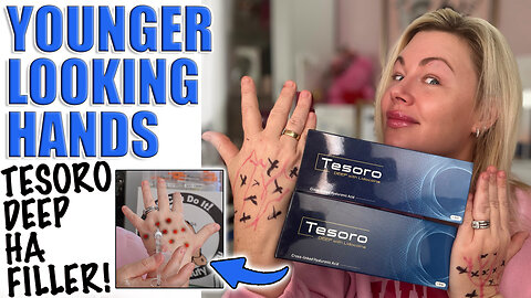 Younger Looking Hands with Tesoro Deep Hyaluronic Acid Filler! AceCosm.com and code Jessica10 Saves