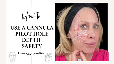 Cannula Technique: Insertion Points, Depth & Safety