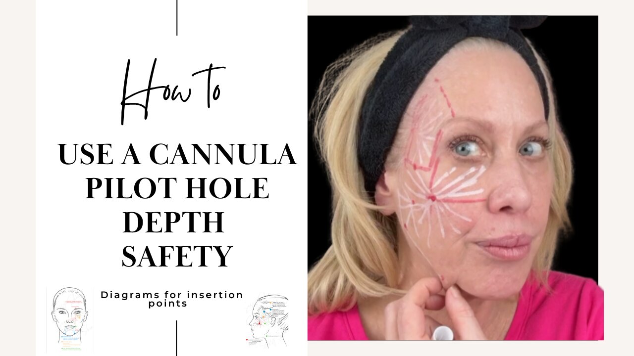 Cannula Technique: Insertion Points, Depth & Safety