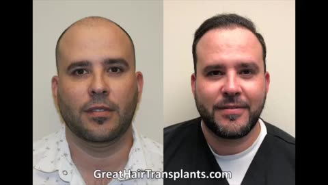 See the 4-Month Transformation After Dr. Brett Bolton’s MaxHarvest™ Hair Transplant