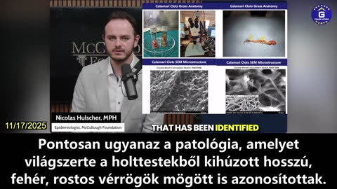 【HU】Minden COVID-19 elleni oltást kapott személy vérében amiloid mikrorögök vannak