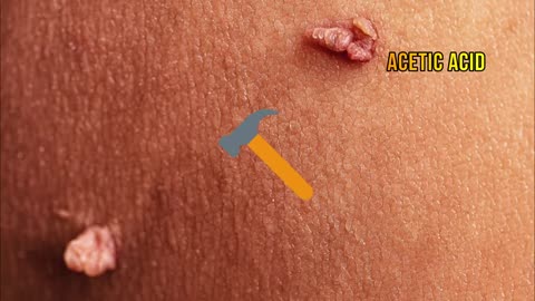 3 Days and Your Skin Tags Will Be Gone