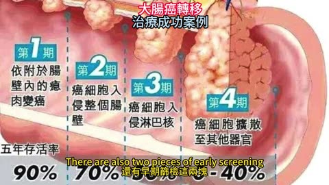 大腸癌轉移 治療成功案例
