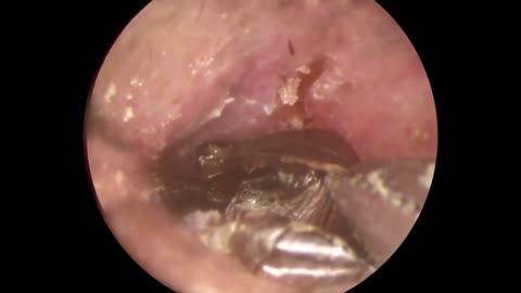 It's not earwax but a Cockroach, see How I got it out