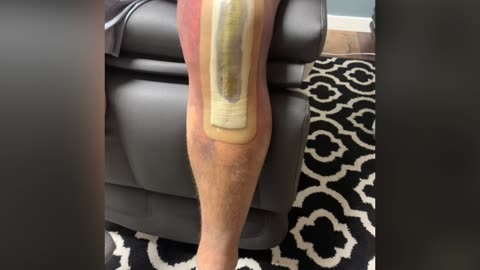 Planning a Knee Surgery?