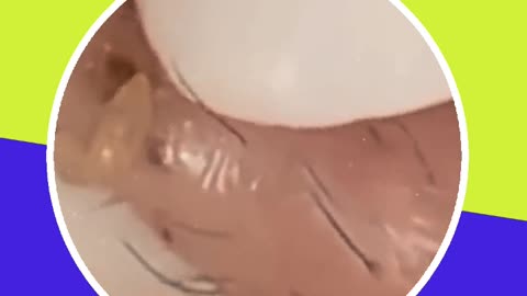Skincare | Blackheads Removal #1 #tweezers #skincare #blackheads