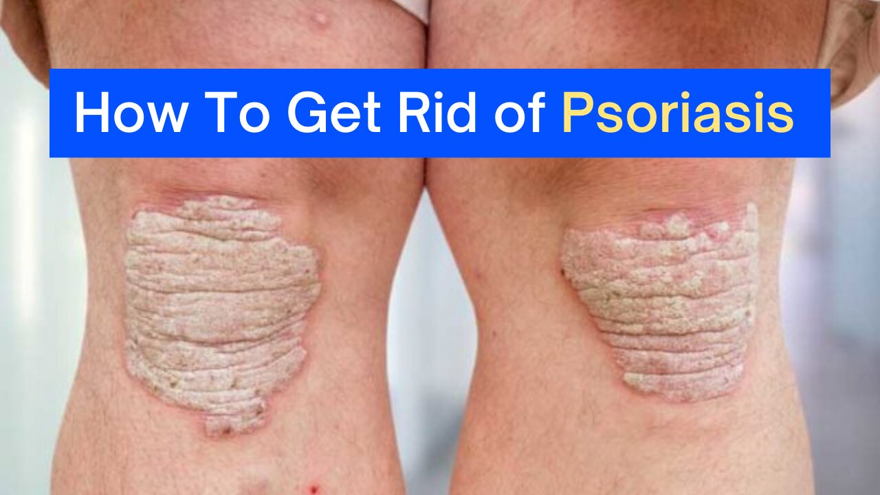 How to cure all types of Psoriasis