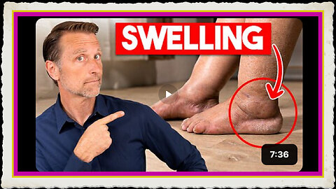 #1 Vitamin to Eliminate Swollen Legs and Ankles