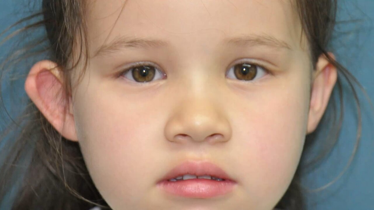 Bespoke otoplasty