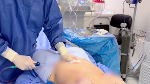 Awake Abdominal Liposuction | No General Anesthesia Needed