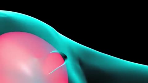 How C-section is performed (3D Animation)