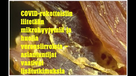 COVID-rokotteisiin liitetään mikrohyytymiä ja huolia verensiirroista