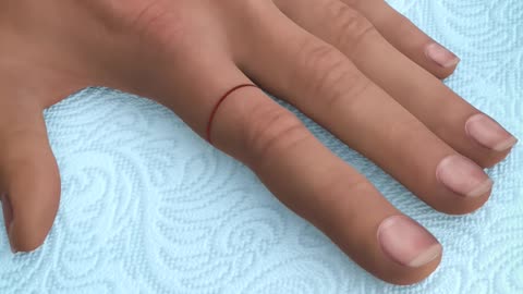 Can You Reattach a Severed Finger?