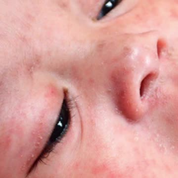 Measles Surge or Vaccine Shedding?