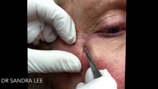 Just popping milia For medical education NSFE