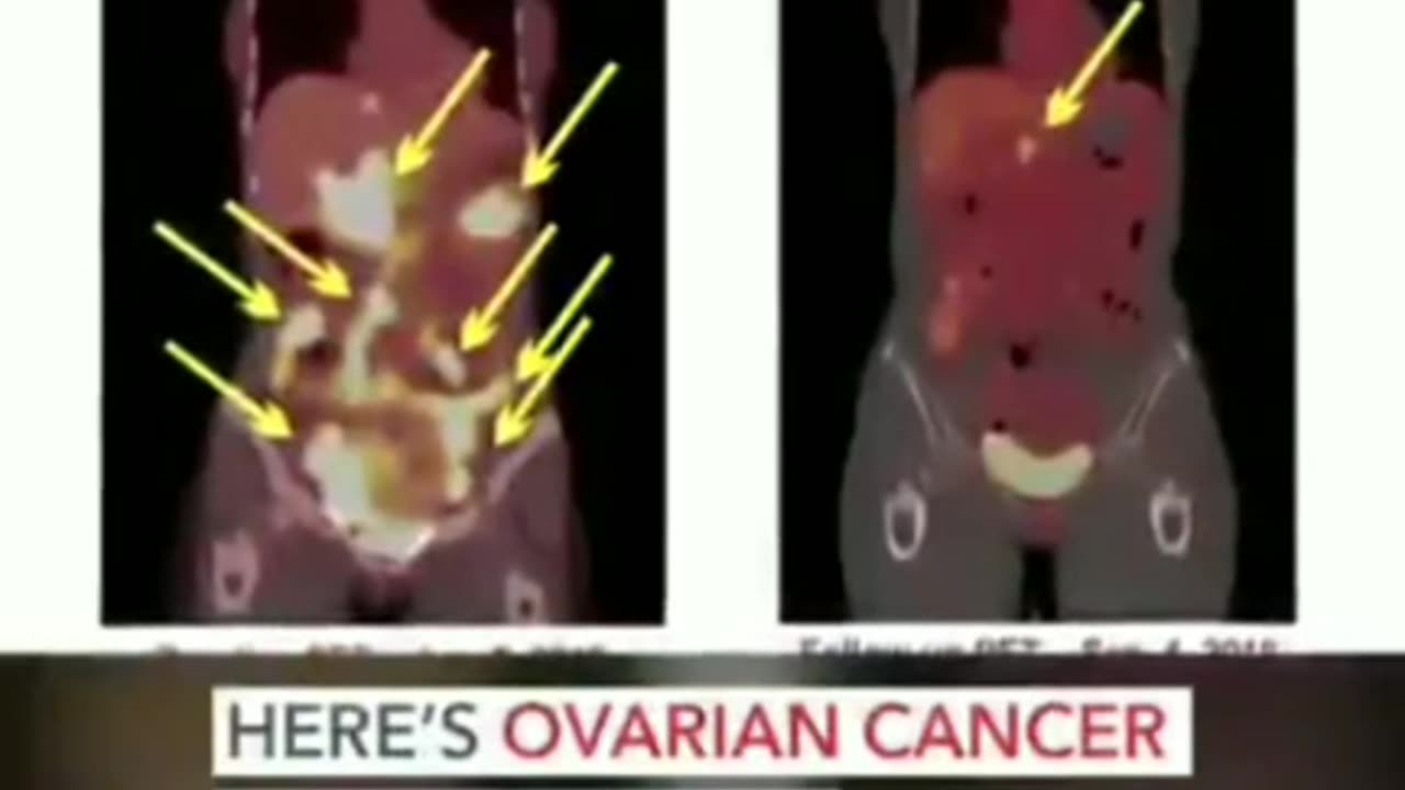 Cancer