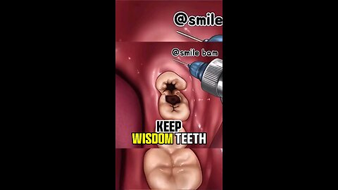 Wisdom Teeth Removal