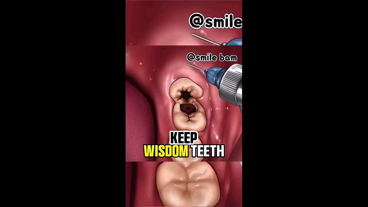 Wisdom Teeth Removal