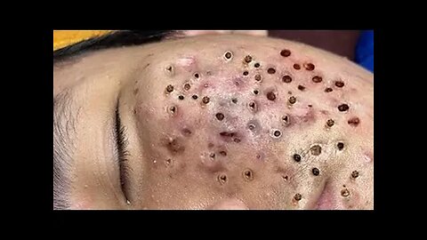 Blackheads Removal & Pimple Popper Cystic Acne Extraction #229