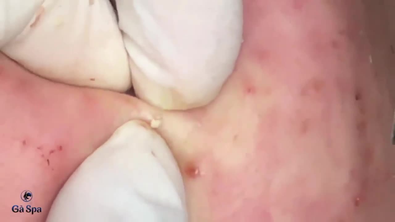 Blackheads Removal & Pimple Popper Cystic Acne Extraction 212
