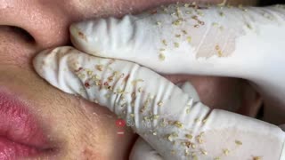 Blackheads Removal & Pimple Popper Cystic Acne Extraction #229