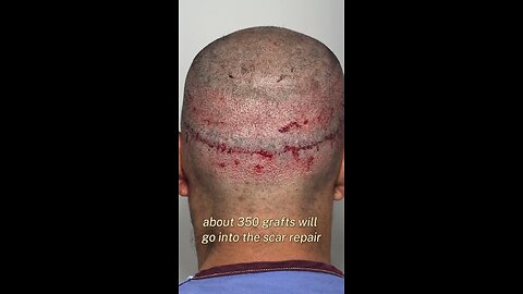 New FUE Procedure!