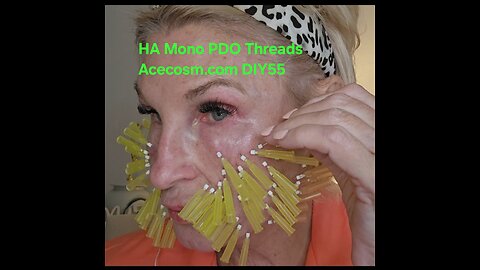 ACECOSM.COM LOWER FACE LIFT HA pdo threads DIY55