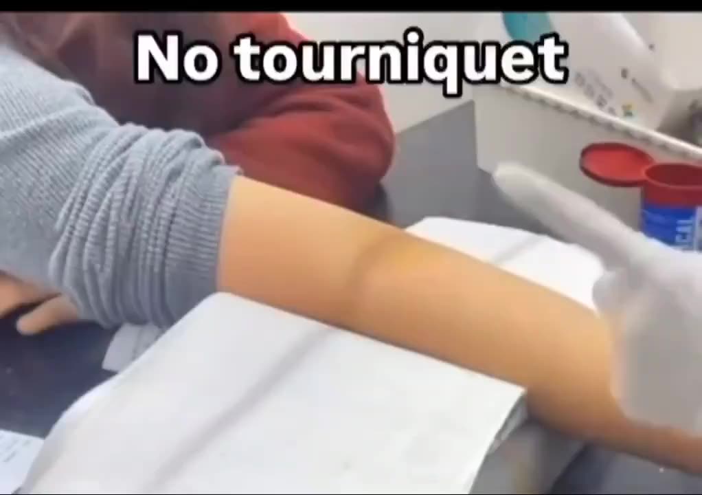 Chinese nurse uses this technique called flying needle to draw blood.