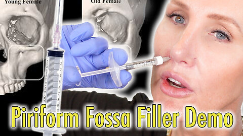 Piriform Fossa Filler Benefits & Demo