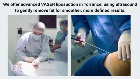 Liposuction Torrance