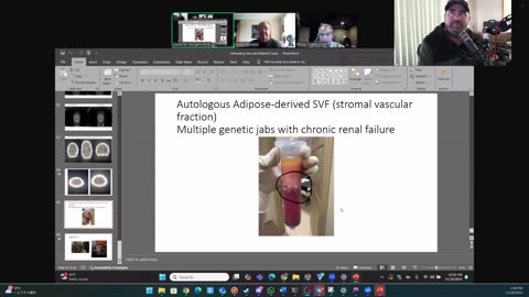 (CLIP) High Amyloidogenicity in Post-Mortem 'Calamari' Clots, Clots and Stem Cells