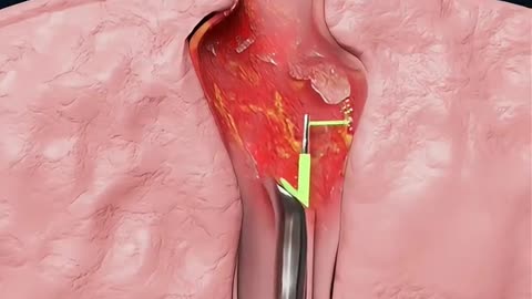 UroLift A Quick Fix for Enlarged Prostate!