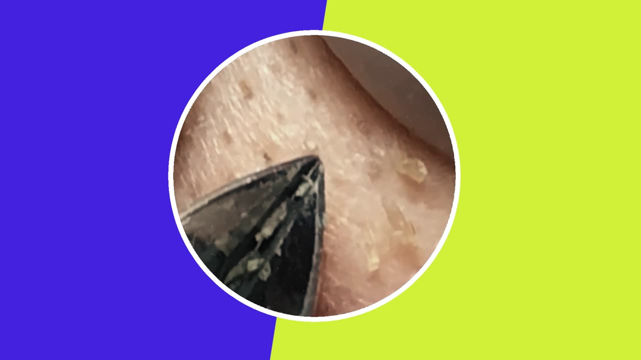 【毛穴 角栓 美容医療】Pimple Removal Satisfying Video (ASMR) #3