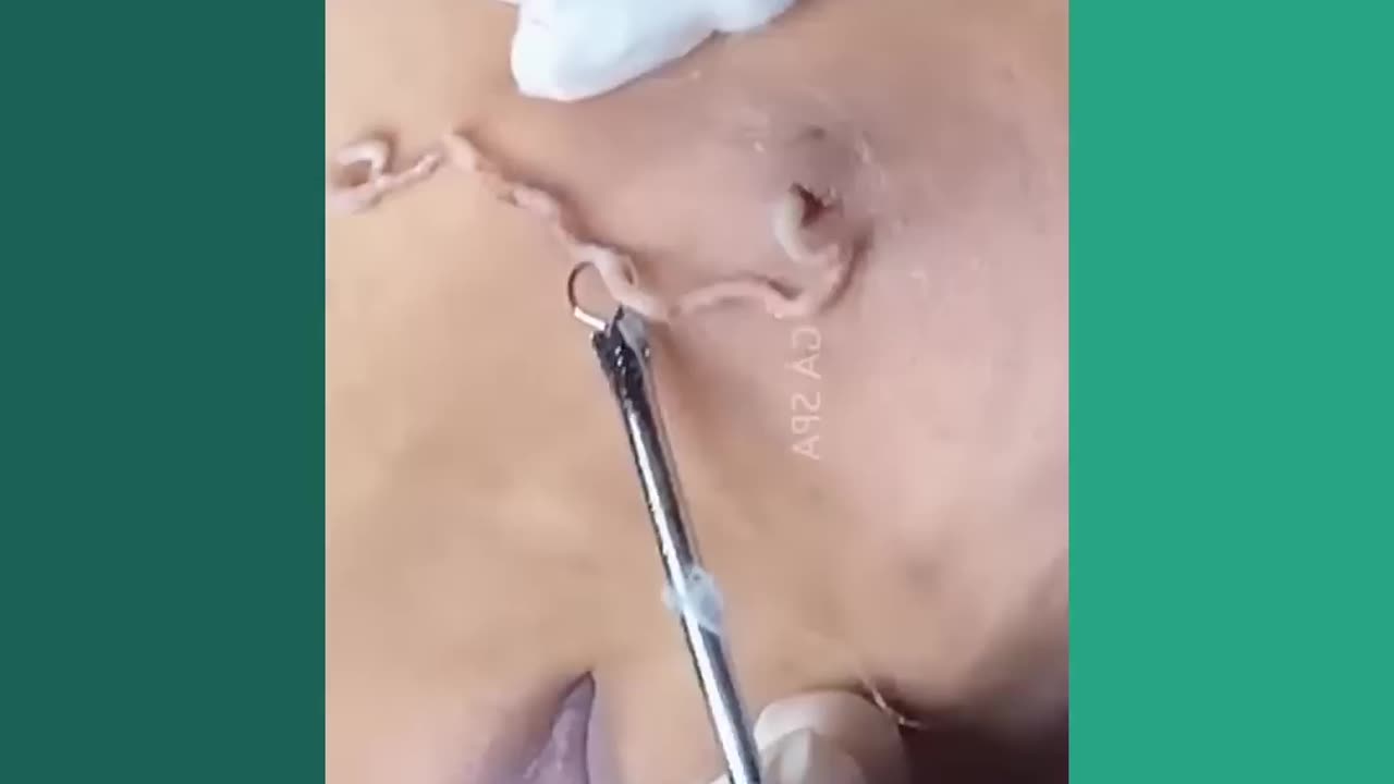 Blackheads Removal & Pimple Popper Cystic Acne Extraction 214