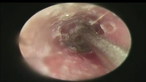 Remove Earwax and Pus by Suction