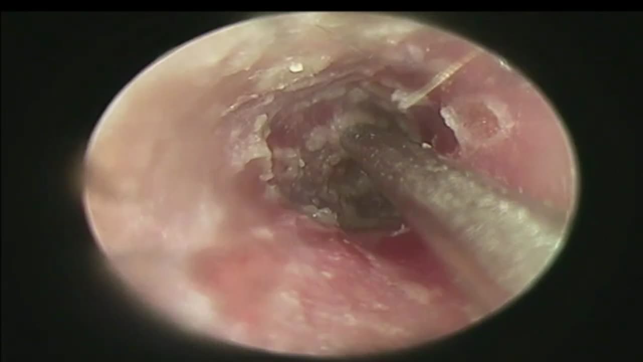 Remove Earwax and Pus by Suction